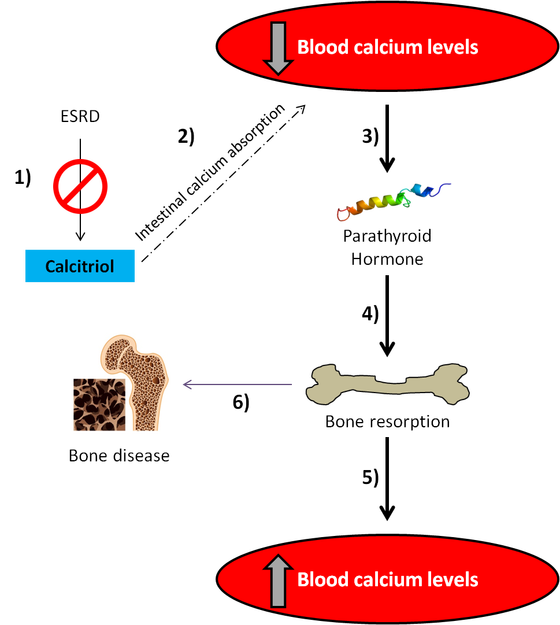 How loss of calcitriol in end-stage renal disease raises PTH and drives bone breakdown